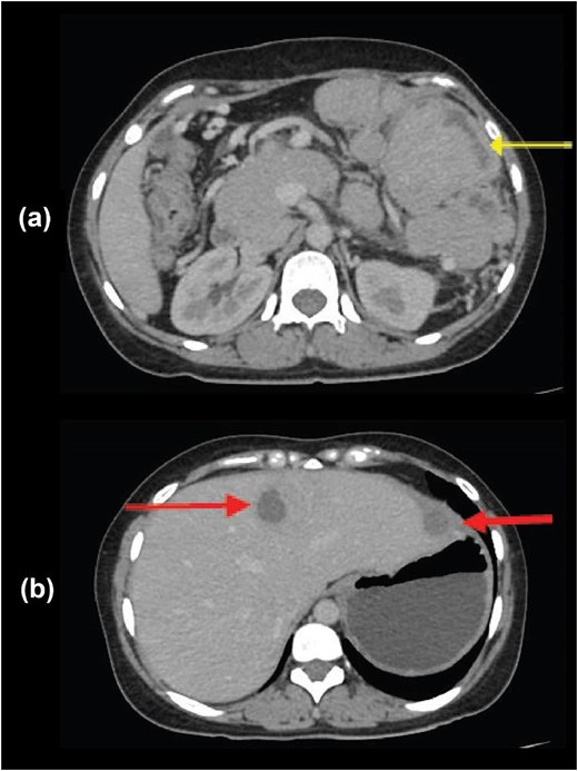 Alt Text: Composite figure containing two axial CT scan images. Panel (a) shows the abdominal cavity containing large, irregular soft-tissue masses in the omentum; An arrow points to a mass with a dark center indicating necrosis. Panel (b) shows the liver parenchyma studded with multiple dark, round spots (hypodense lesions), with arrows pointing to representative examples of metastasis.