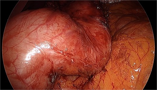 Stricture post Sleeve Gastrectomy