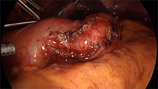 seromyotomy for stricture Sleeve