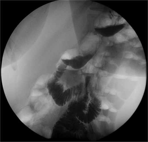 imaging post seromyotomy