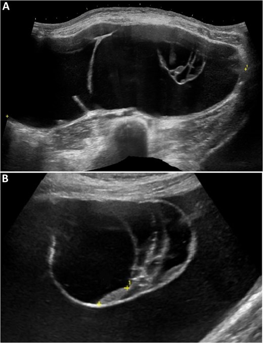 Transabdominal ultrasound images showing a large multiloculated cystic adnexal mass with predominantly anechoic content and internal septations, some appearing thickened, without definite solid components