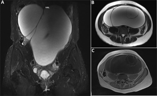 Magnetic resonance imaging demonstrating a giant multiloculated cystic abdominopelvic mass with thick internal septations, occupying most of the abdominal and pelvic cavity, without obvious solid components.