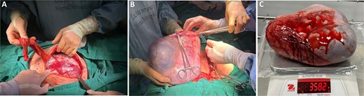 Intraoperative and gross views of a giant ovarian cystic mass removed intact, showing a smooth capsule, and the specimen placed on a surgical scale demonstrating its large size.