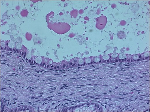 Histopathological image demonstrating a cyst lined by a single layer of mucin-secreting columnar epithelium overlying fibrous stroma, without cytologic atypia or stromal invasion.