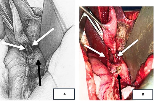 Alt text: Intraoperative photograph (1A) and anatomical diagram (1B) showing two separate cystic ducts indicated by white arrows draining independently into the CBD indicated by a black arrow, consistent with an H-type variant.