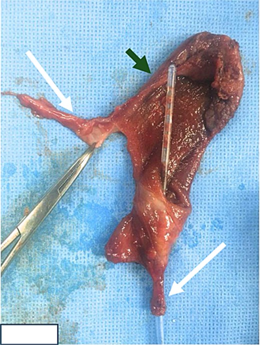Alt text: Photograph of the resected gallbladder specimen showing two cystic duct stumps indicated by white arrows and the gallbladder body indicated by a green arrow.