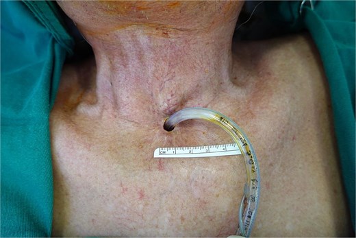 A pre-operative photograph showing a tracheostoma with concentric stenosis due to overhanging skin and scar tissue. A tracheostomy tube is in situ and a ruler shows the stoma measures approximately 7x11mm.