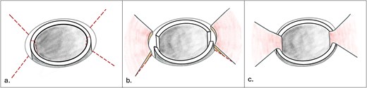 An illustration of the 3 step surgical technique. (a) A tracheostoma with planned radial incisions at 2,4,8 and 10 o' clock positions of the stomal circumference and 2 axial incisions on the lateral tracheal walls. (b) Elevation of laterally based skin flaps. (c) Advancement of the skin flaps and interposition into the lateral tracheal walls.