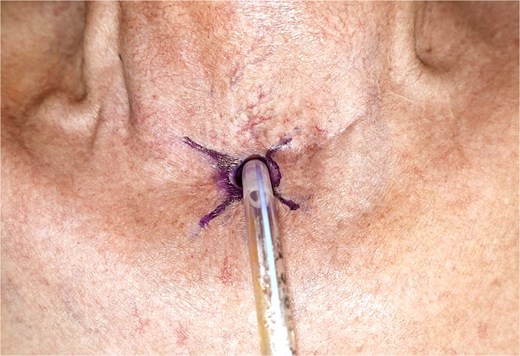 An intraoperative photograph of the tracheostoma with surgical markings in purple ink indicating the radial incisions at 2,4,8 and 10 o'clock positions of the stomal circumference. A tracheostomy tube is in situ.