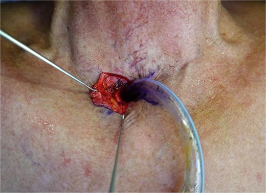 An intra-operative photograph showing elevation of a laterally based skin flap on the right side of the tracheostoma. Skin hooks retract the tissue, demonstrating broad based advancement flaps. A tracheostomy tube is in situ.