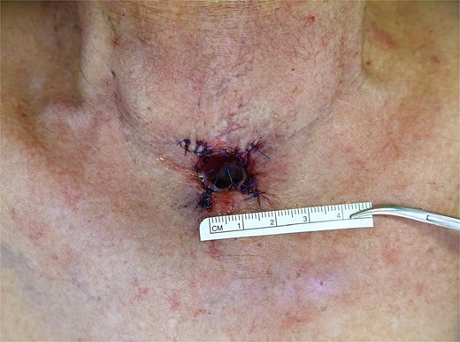 Immediate post-operative appearance of the tracheostoma following flap inset, with sutures in situ. The stoma is enlarged, with a ruler placed inferiorly indicating a size of approximately 15 x 11 mm. The tracheostomy tube has been removed.