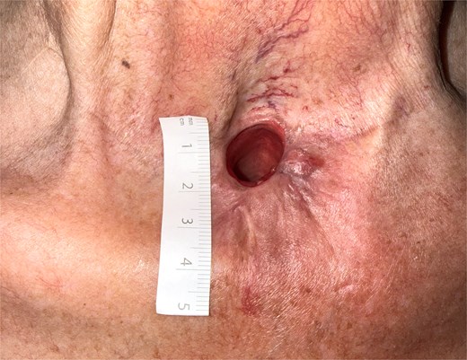 Post-operative appearance at 2-months follow up showing a widely patent tracheostoma. A ruler demonstrates an increased size of approximately 18x20mm.