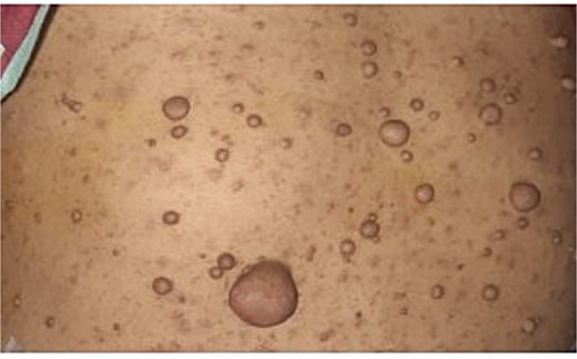 Clinical photograph showing multiple cutaneous lesions distributed over the patient's body.