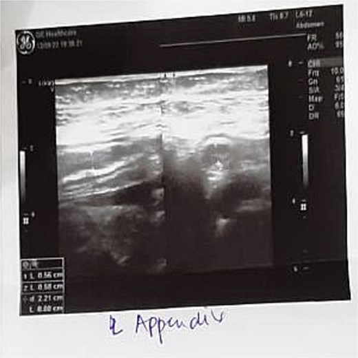 Ultrasound image demonstrating a blind-ending tubular structure in the right iliac fossa with adjacent free fluid.