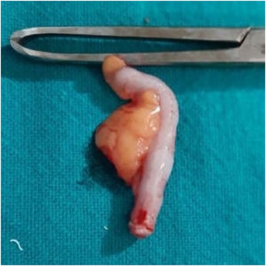 Post-operative photograph demonstrating a normal-appearing appendix with no visible signs of inflammation or perforation.