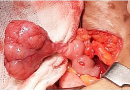 Intraoperative photograph demonstrating an exophytic mass arising from the ileum.
