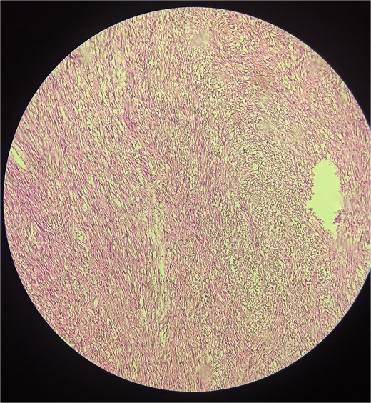 Microscopic image demonstrating spindle-shaped cells in a fascicular pattern with alternating Antoni A (hypercellular) and Antoni B (hypocellular) areas, characteristic of schwannoma.
