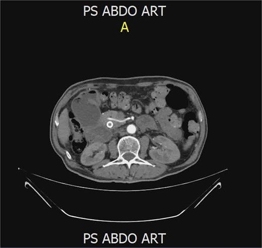 CT image demonstrating an anomalous right hepatic artery originating from the SMA passing within the pancreatic head.