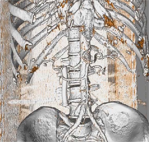 3D CT image showing an anomalous right hepatic artery originating from the SMA and passing within the pancreatic head, supplying the entire liver.