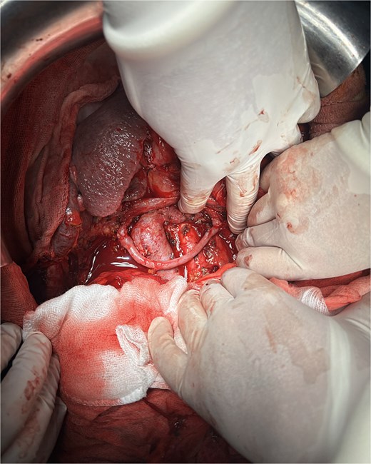 Surgical exposure of the anomalous hepatic artery during Whipple procedure.