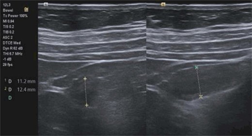 Preoperative abdominal ultrasound image showing an enlarged, inflamed appendix measuring approximately 11-12 mm with surrounding periappendiceal inflammatory change. Mild bilateral hydronephrosis is also present.