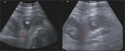 Postoperative ultrasound showing a heterogeneous right lower abdominal fluid collection with surrounding fat infiltration.