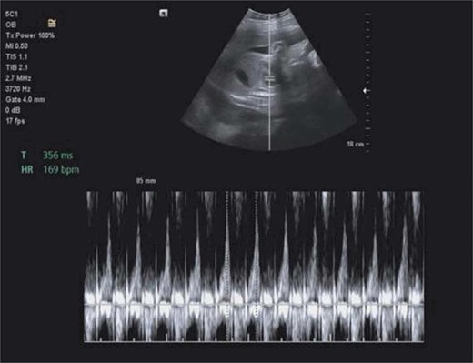 Obstetric ultrasound showing a viable intrauterine pregnancy at approximately 27 weeks with fetal heart rate of 169 bpm.