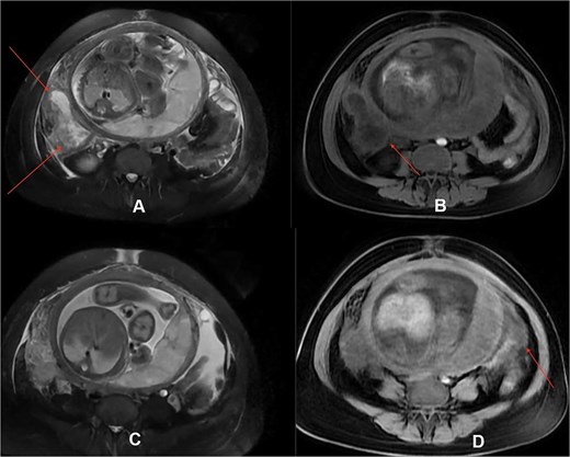 Contrast-enhanced MRI showing a right lower abdominal peri-cecal abscess closely abutting the uterus, with associated intraperitoneal fluid suspicious for purulent peritonitis.
