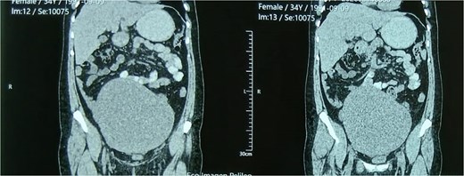 ``Contrast-enhanced coronal CT scan showing a markedly enlarged uterus (approximately 19 x 12 cm) containing a large heterogeneous multinodular solid mass with lobulated contours, displacing adjacent bowel loops superiorly without evidence of invasion.''