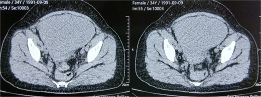 Axial pelvic CT scan showing a bulky intramural uterine mass with heterogeneous attenuation and multinodular architecture, displacing the urinary bladder anteriorly, with preserved fat planes indicating no evidence of local invasion.