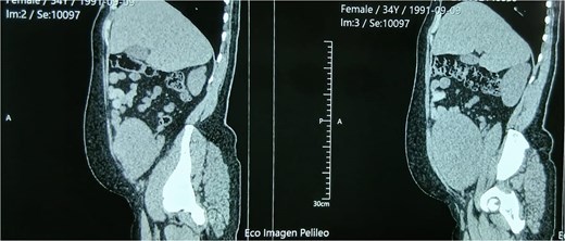 Sagittal contrast-enhanced CT reconstruction showing cranio-caudal extension of a uterine mass into the lower abdomen, with distortion of normal pelvic anatomy and no evidence of extrauterine spread.