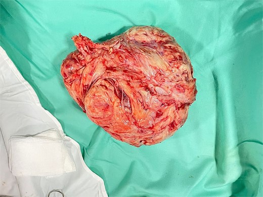 Macroscopic surgical specimen after enucleation showing a well-circumscribed multinodular leiomyoma measuring approximately 19 x 14 cm and weighing about 1.6 kg.