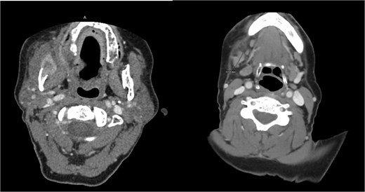 Axial contrast-enhanced CT images of the neck demonstrating an infiltrative soft tissue mass involving the right hemimandible with surrounding soft tissue invasion, along with enlarged right level IB lymph nodes.