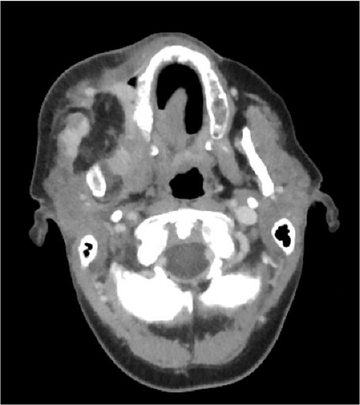 Axial contrast-enhanced CT image of the neck showing a focal enhancing lesion deep to the surgical resection cavity within the pterygoid musculature, consistent with suspected residual or recurrent disease.