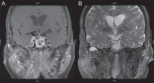 Coronal contrast-enhanced MRI images of the brain demonstrating a heterogeneously enhancing sellar mass with extension into the bilateral cavernous sinuses.
