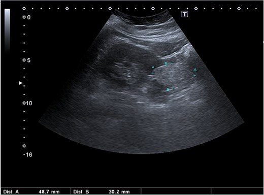 US examination of the abdomen showed a left renal mass.