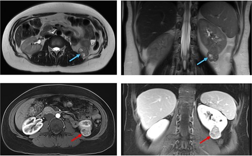 MRI examination of the abdomen showed a partially exophytic left renal mass on T2 sequence (blue arrows), and on contrasted T1 sequence (red arrows).