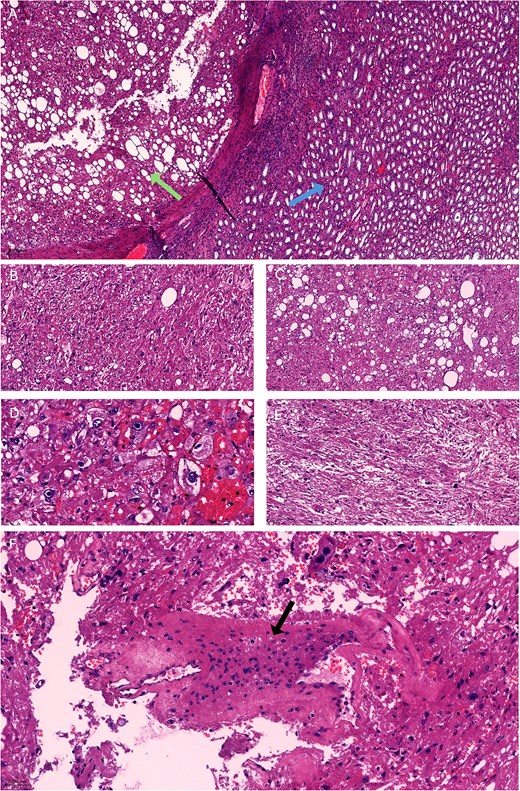 Histopathology showed (A) A well-circumscribed lesion with a capsule (green arrow) separating it from the adjacent renal parenchyma (blue arrow) (H and E, x50). (B and C) The lesion consisted of diffuse sheets of epithelioid cells, plump spindle cells, and adipocytes (H and E, x200). (D) Epithelioid cells with eosinophilic cytoplasm and atypical nuclei bearing prominent nucleoli, some of the epithelioid cells showed clear or finely granular cytoplasm, and mostly uniform nuclei (H and E, x400). (E) Plump spindle cells. (H and E, x200). (F) Thickened irregular blood vessels with partial branching (black arrow) (H and E, x200).