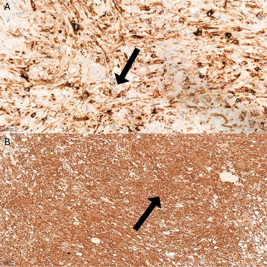 Immunohistochemical analysis showed (A) Epithelioid cells demonstrated diffuse and strong cytoplasmic positivity for HMB-45, indicated by intense dark brown staining (IHC, x200). (B) Smooth muscle actin (SMA) showed positive cytoplasmic staining in both spindle-shaped and epithelioid smooth muscle cells, evidenced by dark brown coloration (IHC, x40).