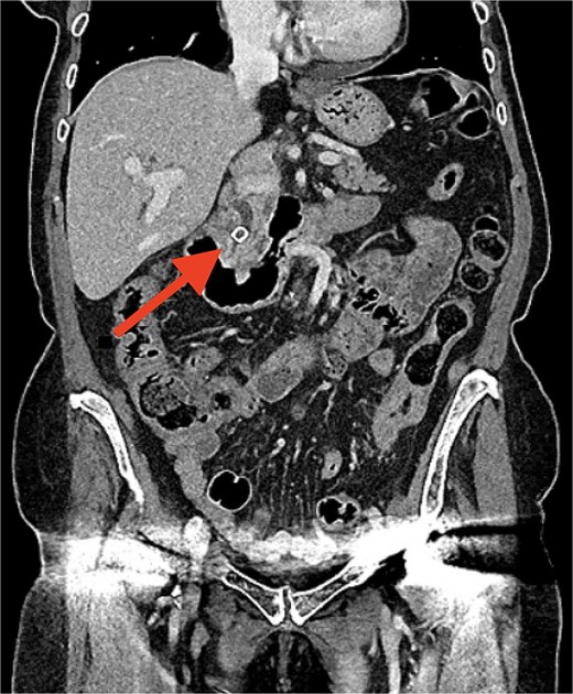 Grayscale coronal CT scan of the abdomen and pelvis showing internal organs, including the liver on the upper left and loops of intestine throughout the center. A red arrow points to a small, bright (dense) structure near the central upper abdomen, which is the gallstone impacted at the distal common bile duct and causing upstream dilatation.