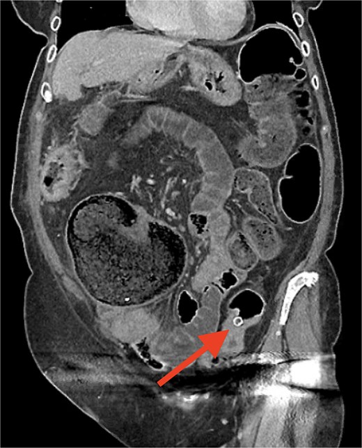 Grayscale coronal CT scan of the abdomen and pelvis showing the liver at the upper left, and dilated bowel loops throughout the centre. A red arrow points to a small, round, bright (dense) spot in the lower right of the image which represents the gallstone, obstructing at a narrowing in the colon.