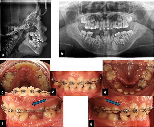 Pre-treatment clinical and radiographic records of a patient with cleft lip and palate, including lateral cephalogram, panoramic radiograph, and intraoral photographs showing impacted maxillary canines.