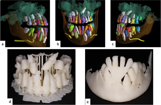 Pre-treatment CBCT-based AI segmentation of maxillary structures and impacted canines, along with a patient-specific 3D-printed anatomical model used for surgical planning.