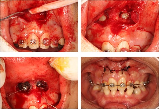 Intraoperative views demonstrating surgical exposure of impacted maxillary canines using a 3D-guided approach, including flap elevation, bone exposure, and attachment placement.