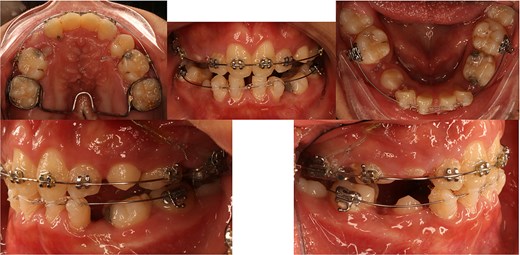 Intraoral photographs taken two weeks after surgery showing healing of palatal tissues and initiation of light orthodontic traction using a transpalatal arch.