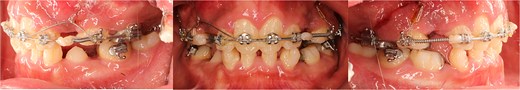 Intraoral views showing extraction of maxillary first premolars after three months of orthodontic traction to create space for canine alignment.