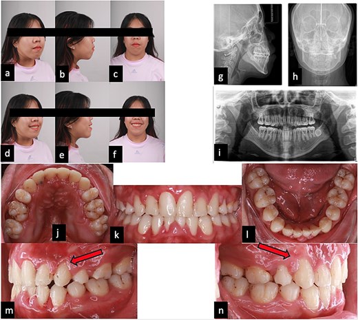 Post-treatment clinical records including extraoral photographs, radiographic images, and intraoral views demonstrating alignment of maxillary canines and improved occlusion.