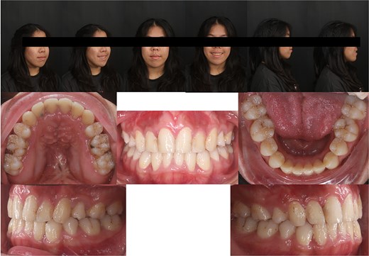 One-year follow-up intraoral and extraoral photographs demonstrating stable occlusion, aligned dentition, and maintained treatment outcomes.