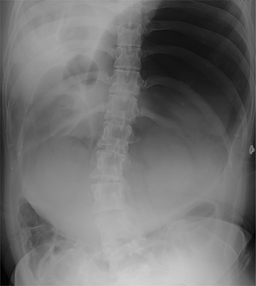 Abdominal radiograph showing marked gastric dilatation consistent with proximal intestinal obstruction.