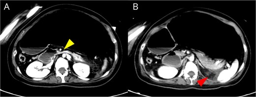 Contrast-enhanced CT images showing duodenal compression between the aorta and superior mesenteric artery with proximal dilatation, and peripancreatic fat stranding without necrosis.
